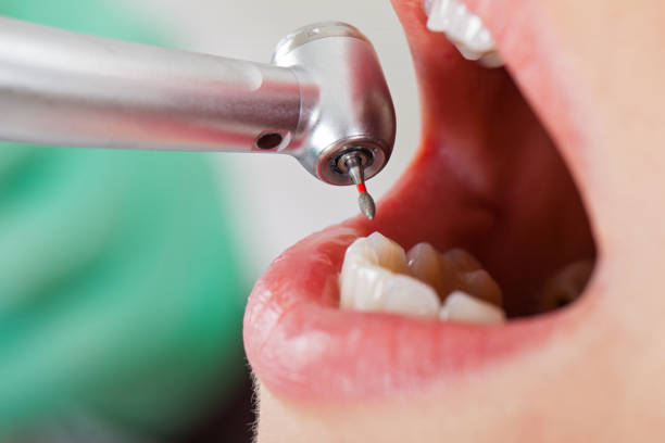 Best Broken or Cracked Tooth Emergency Dentist in Costa Mesa, CA